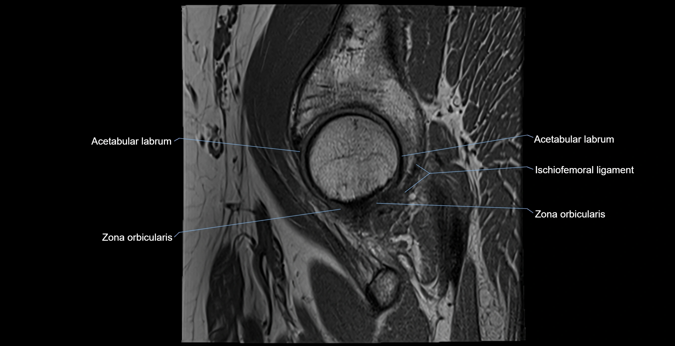 MRI Hip ligaments sagittal cross sectional anatomy 3T  radiology  image-img-00001-00008.webp
